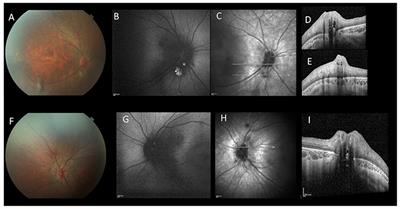 Case Report: Multiple Retinal Astrocytic Hamartomas in Congenital Disorder of Glycosylation-Ia